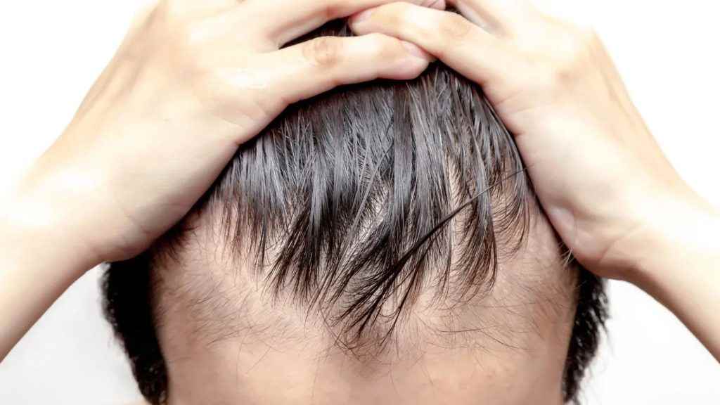 Hair-Fall-treatment-kudasan-gandhinagar-hair-growth-1024x576